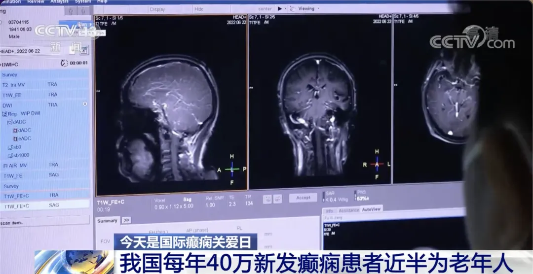 第十八个国际癫痫关爱日，癫痫患者征集计划火热进行中，可申请3000-10000元的公益基金援助!!!