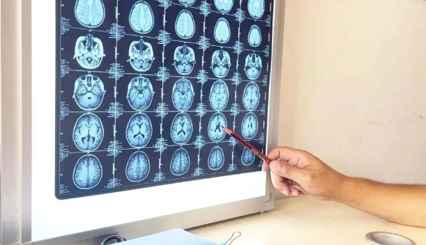 难治性癫痫≠终局！医生：这3条新路径，很多人不知道