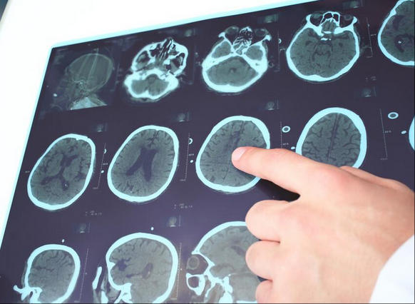 癫痫会遗传吗？这2种情况，遗传风险高到需警惕