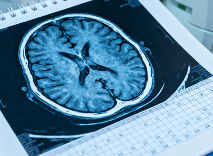 为什么癫痫越治越重？90% 的人都犯了同一个错