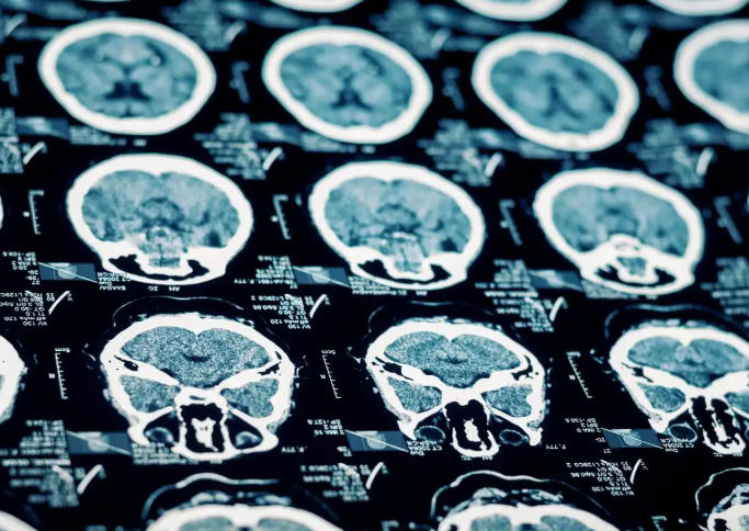 分清两种癫痫！原发性vs继发性，差别太大，别再混淆了