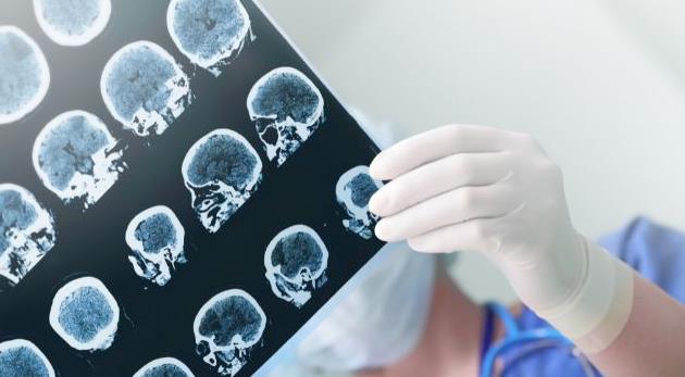 夫妻一方存在癫痫病史，备孕、日常体检要加做脑部筛查吗？